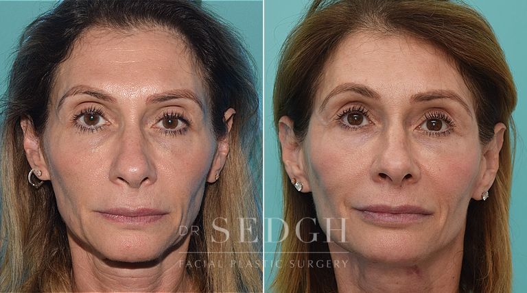 patient before and after face and neck procedure