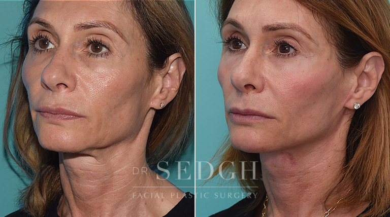 patient before and after face and neck procedure