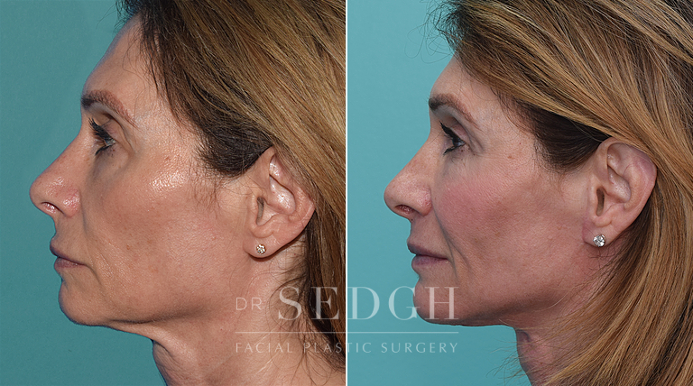 patient before and after face and neck procedure