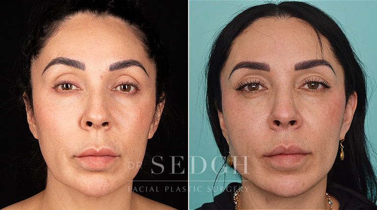 patient before and after face and neck procedure