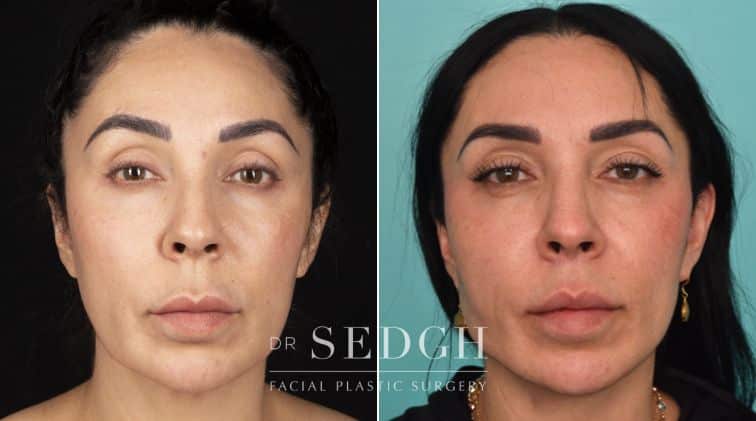 patient before and after face and neck procedure