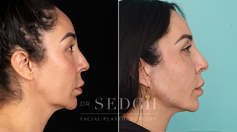 patient before and after face and neck procedure