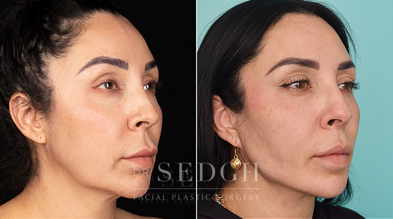 patient before and after face and neck procedure