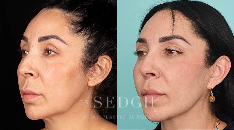 patient before and after face and neck procedure