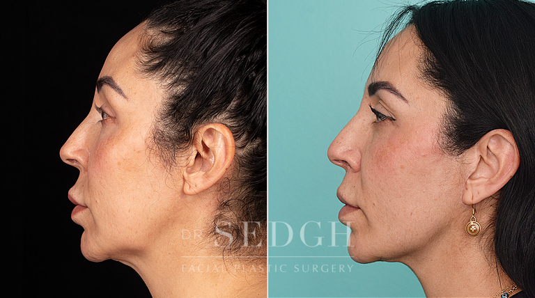 patient before and after face and neck procedure