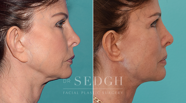 patient before and after face and neck procedure