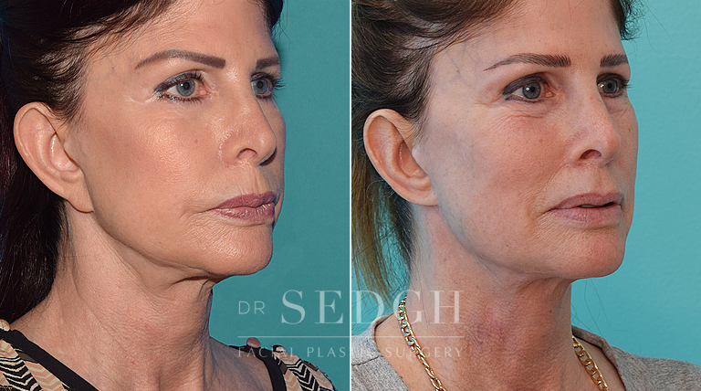 patient before and after face and neck procedure