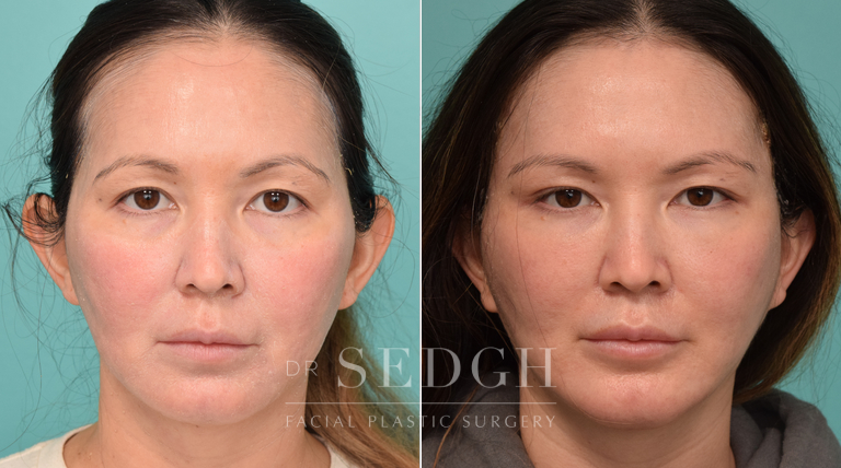 Female Patient Before and After Facelift, Brow Lift, Chin Augmentation | Sedgh