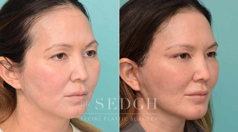 Female Patient Before and After Facelift, Brow Lift, Chin Augmentation | Sedgh