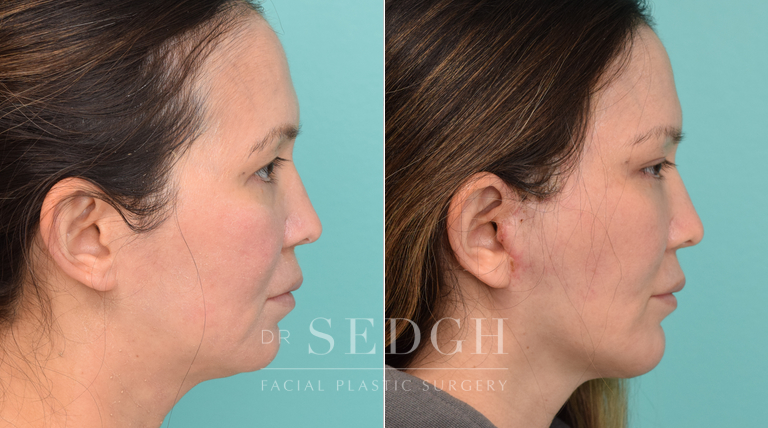 Female Patient Before and After Facelift, Brow Lift, Chin Augmentation | Sedgh