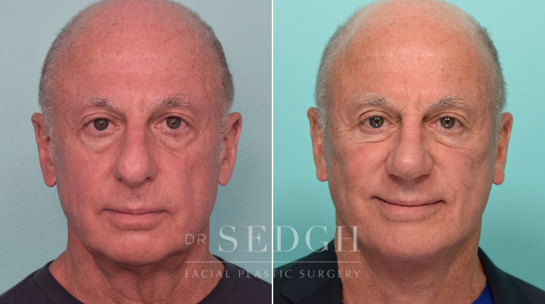 Facelift, Chin Augmentation and Rhinoplasty Before and After | Sedgh