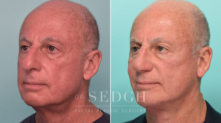Facelift, Chin Augmentation and Rhinoplasty Before and After | Sedgh