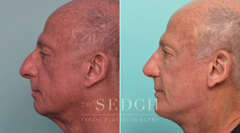 Facelift, Chin Augmentation and Rhinoplasty Before and After | Sedgh