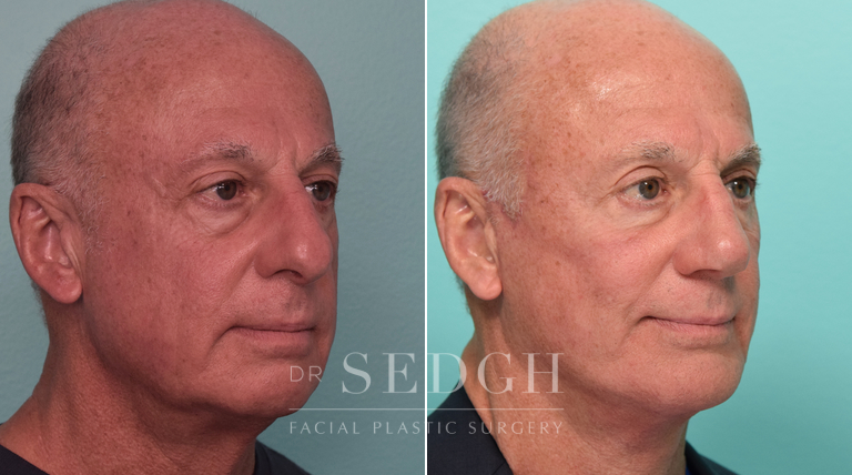 Facelift, Chin Augmentation and Rhinoplasty Before and After | Sedgh