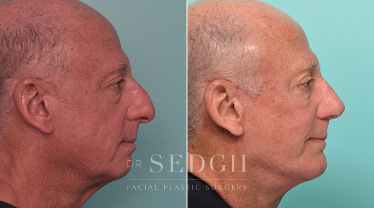 Facelift, Chin Augmentation and Rhinoplasty Before and After | Sedgh