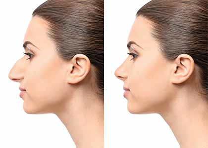 Young woman before and after rhinoplasty