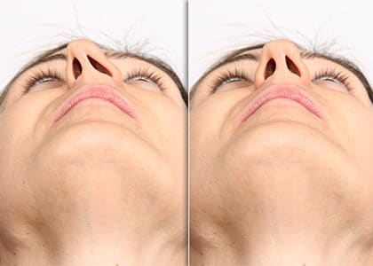 before and after septoplasty surgery comparison