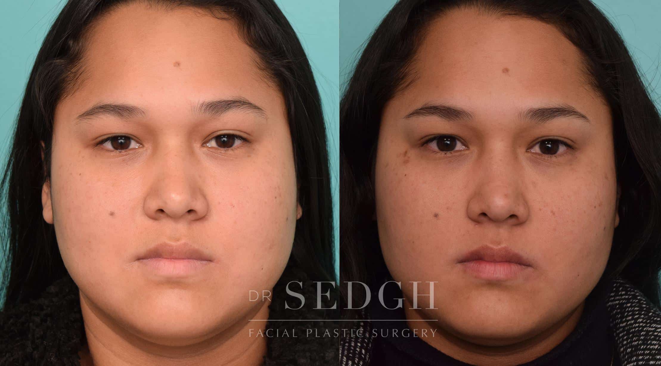 Buccal Fat Reduction Before and After Photos Dr. Sedgh
