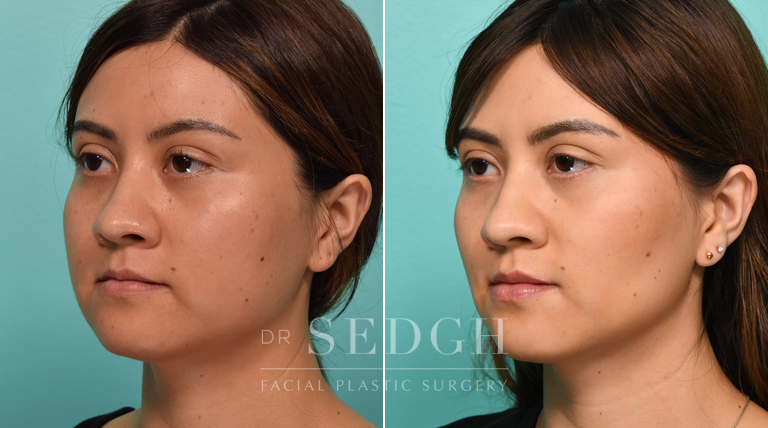 Female Patient Before and After Buccal Fat Reduction | Sedgh