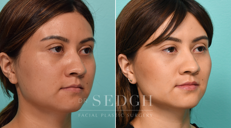 Female Patient Before and After Buccal Fat Reduction | Sedgh