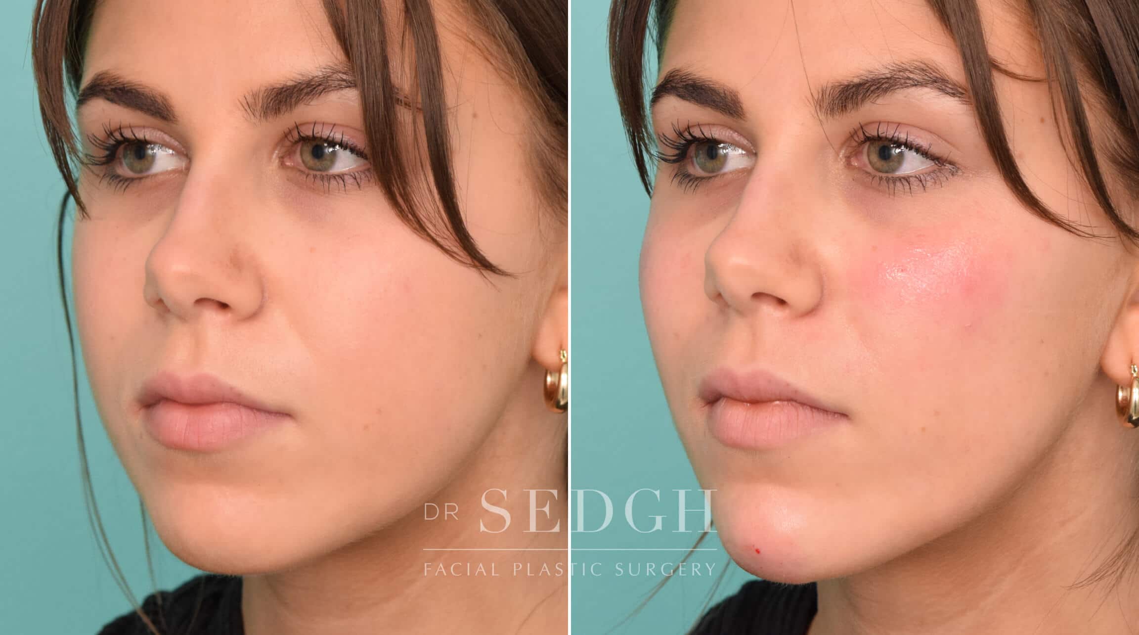 Chin Filler Before and After Photos Sedgh Plastic Surgery