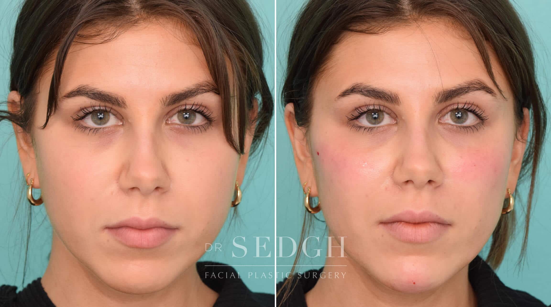 Chin Filler Before and After Photos Sedgh Plastic Surgery
