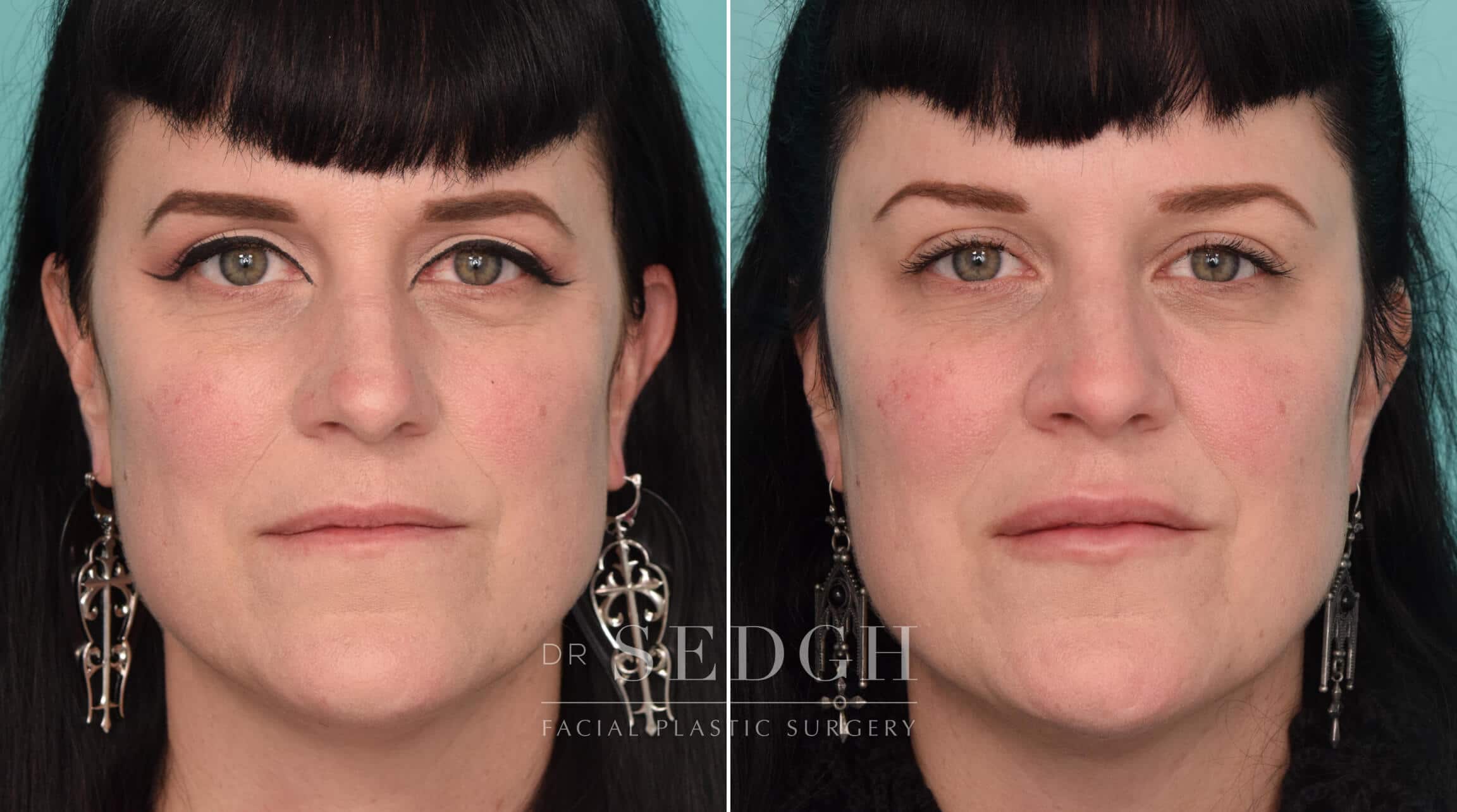 Temple Filler Before and After Photos  Dr. Jacob Sedgh