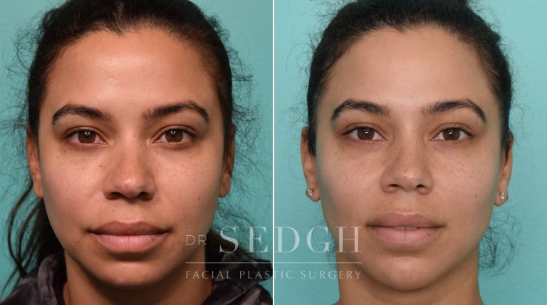 patient before and after buccal fat reduction