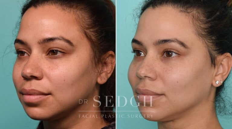 patient before and after buccal fat reduction