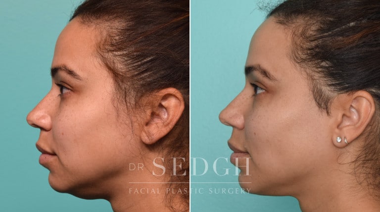 patient before and after buccal fat reduction
