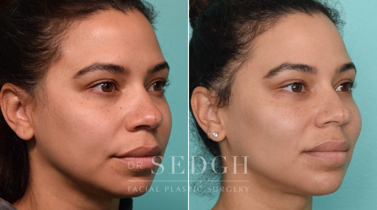 patient before and after buccal fat reduction