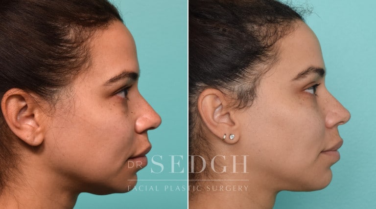 patient before and after buccal fat reduction