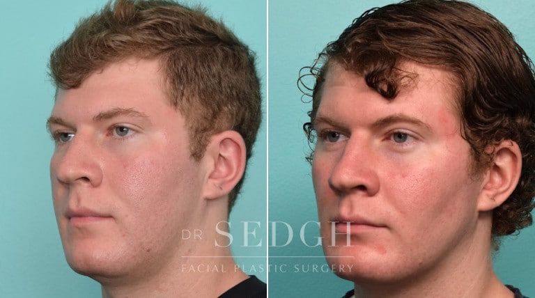 patient before and after buccal fat reduction