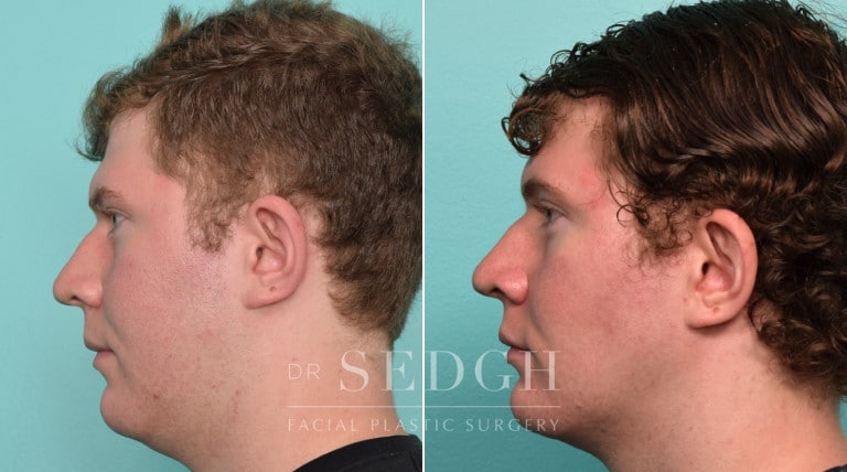 patient before and after buccal fat reduction