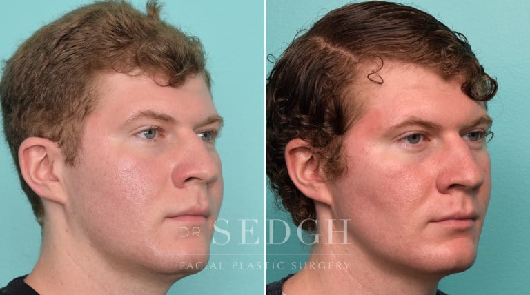 patient before and after buccal fat reduction