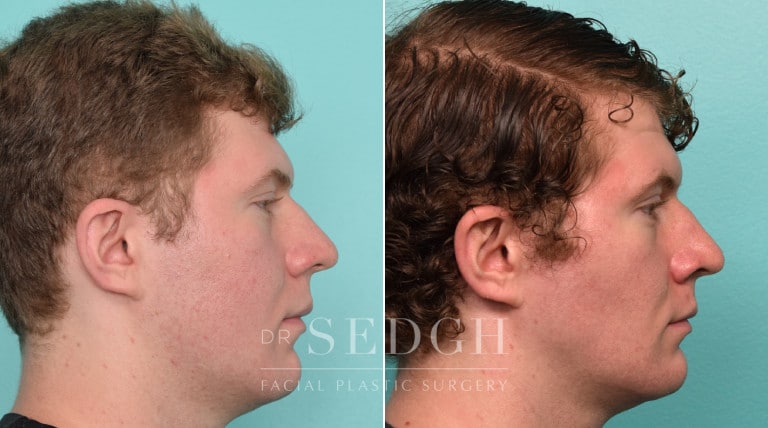 patient before and after buccal fat reduction