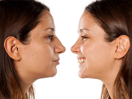 Before and after rhinoplasty
