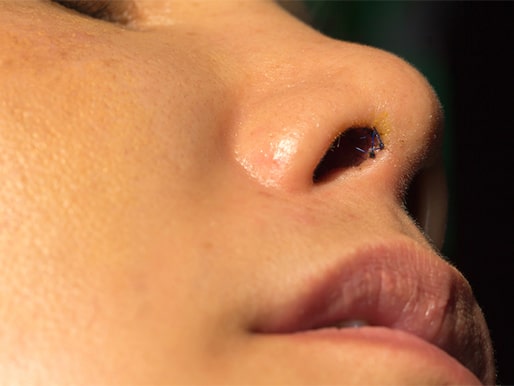 Close up image of a woman's nose with surgical scar inside nose hole after surgery