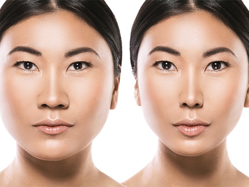 Result of plastic surgery of an Asian woman