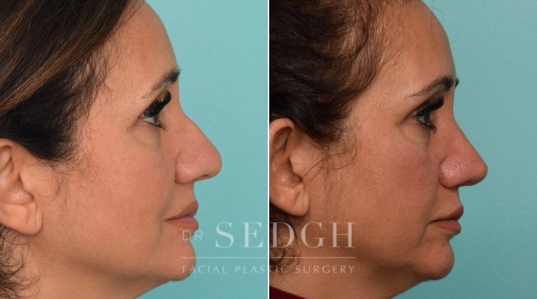 patient before and after rhinoplasty procedure | Sedgh