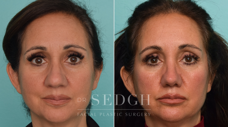 patient before and after rhinoplasty procedure