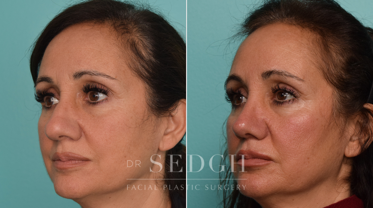 patient before and after rhinoplasty procedure