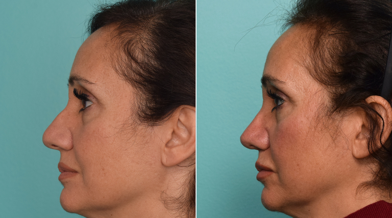 patient before and after rhinoplasty procedure