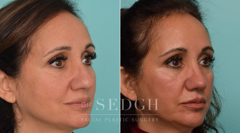 patient before and after rhinoplasty procedure