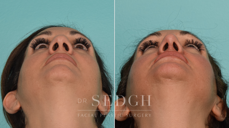 patient before and after rhinoplasty procedure