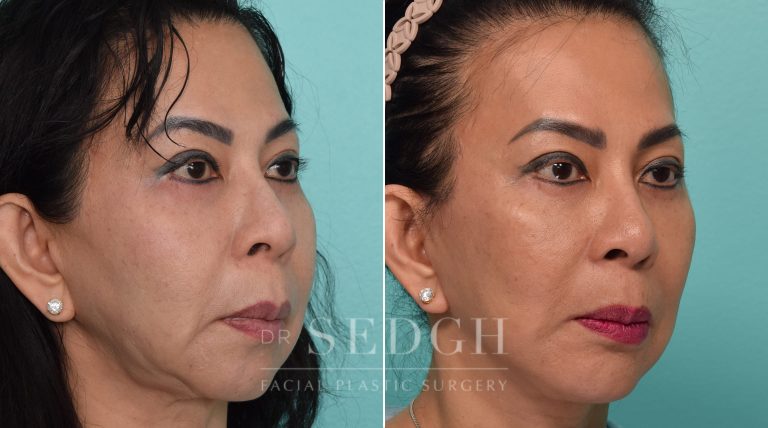 Revision Facelift and Chin Augmentation Before and After | Sedgh