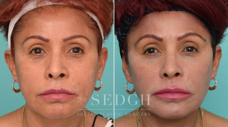 Female Patient Before and After Revision Facelift, Mini Facelift, Fat Grafting | Sedgh