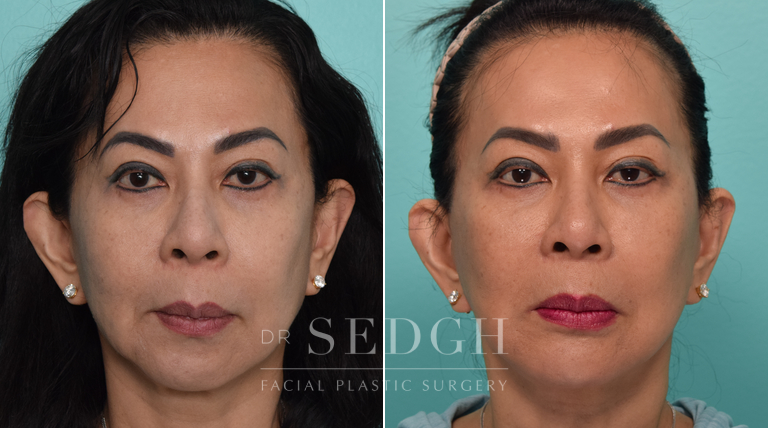 Revision Facelift and Chin Augmentation Before and After | Sedgh