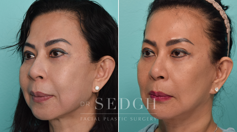 Revision Facelift and Chin Augmentation Before and After | Sedgh