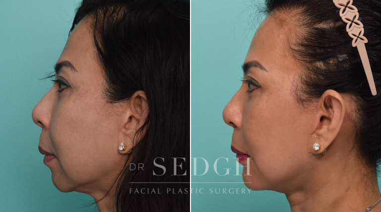 Revision Facelift and Chin Augmentation Before and After | Sedgh